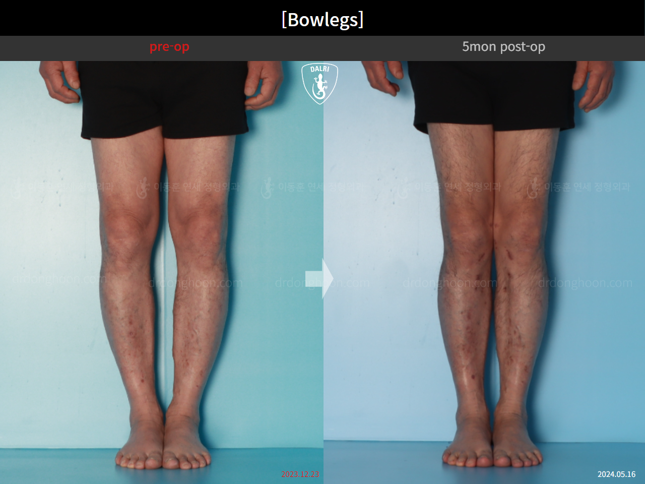 Before and after adult bowlegs, case 24988060, image 6, Dr. Donghoon institute (DALRI)
