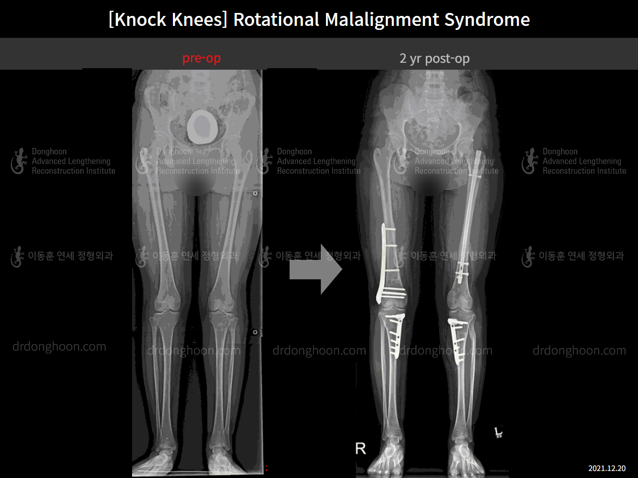 Before and after adult knock knees, case 9232717, image 3, Dr. Donghoon institute (DALRI)