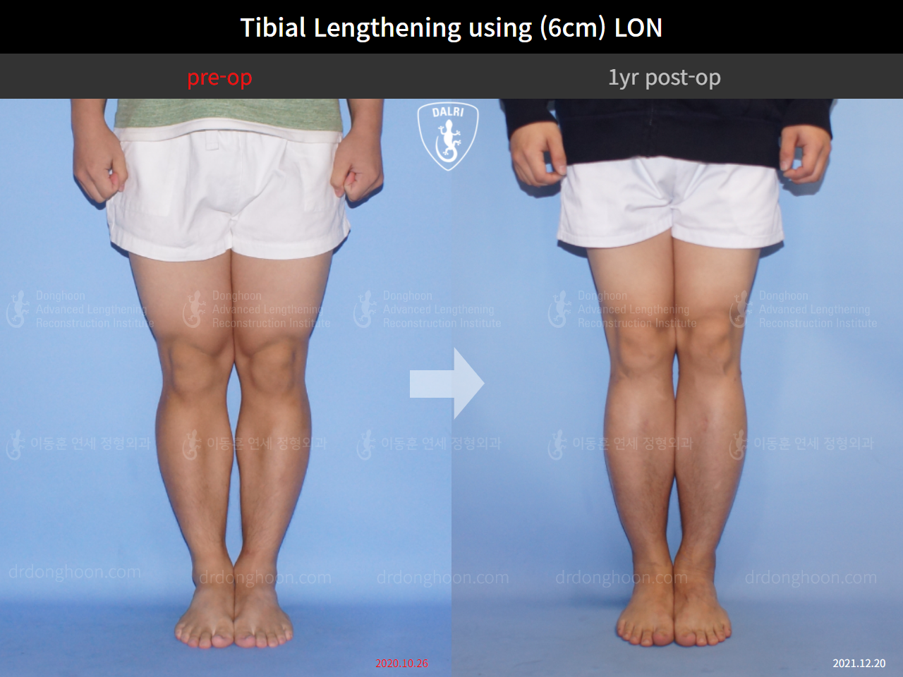 Before and after cll lon, case 4323461, image 5, Dr. Donghoon institute (DALRI)