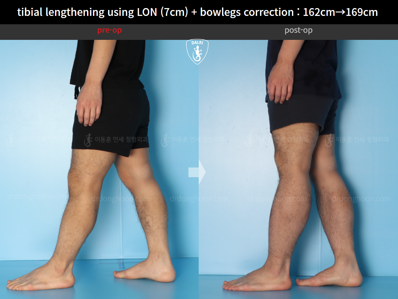 Before and after cll + deformity correction, case 15545055, image 8, Dr. Donghoon institute (DALRI)