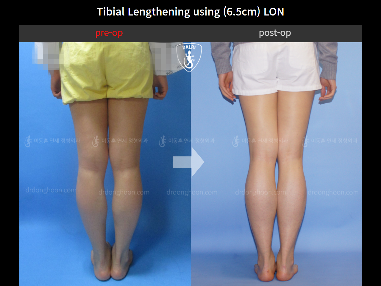 Before and after cll lon, case 4323483, image 4, Dr. Donghoon institute (DALRI)