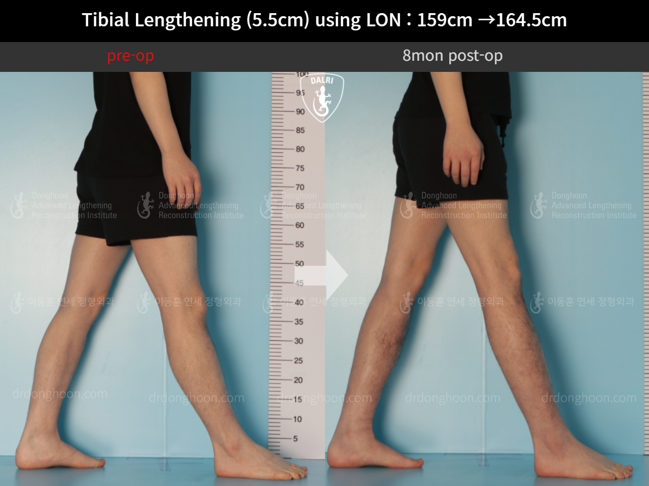 Before and after cll lon, case 10444923, image 8, Dr. Donghoon institute (DALRI)