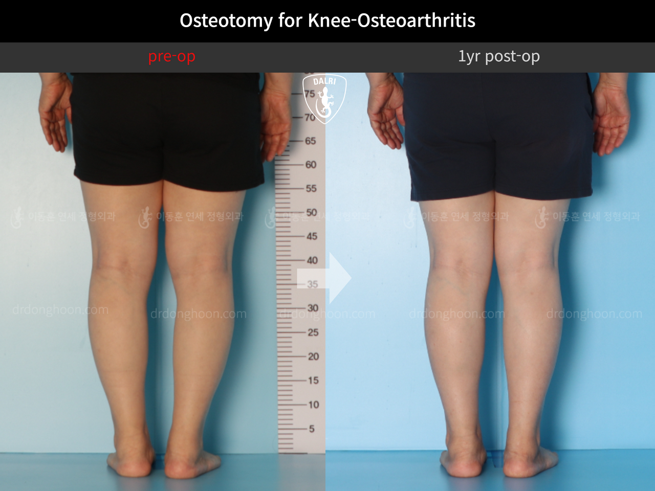 Before and after osteotomy for knee osteoarthritis, case 13231794, image 4, Dr. Donghoon institute (DALRI)