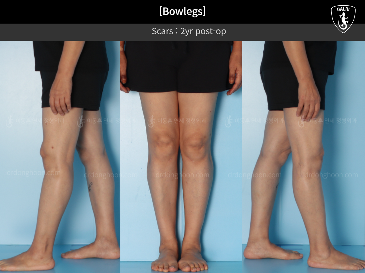 Before and after adult bowlegs, case 13250883, image 7, Dr. Donghoon institute (DALRI)