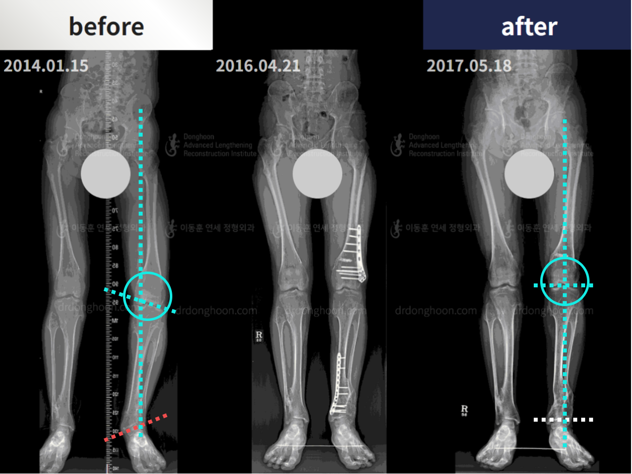 Before and after foot & ankle deformity, case 4596501, image 2, Dr. Donghoon institute (DALRI)