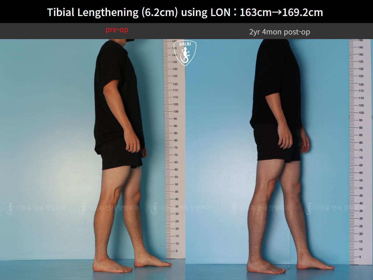 Before and after cll lon, case 128449546, image 6, Dr. Donghoon institute (DALRI)