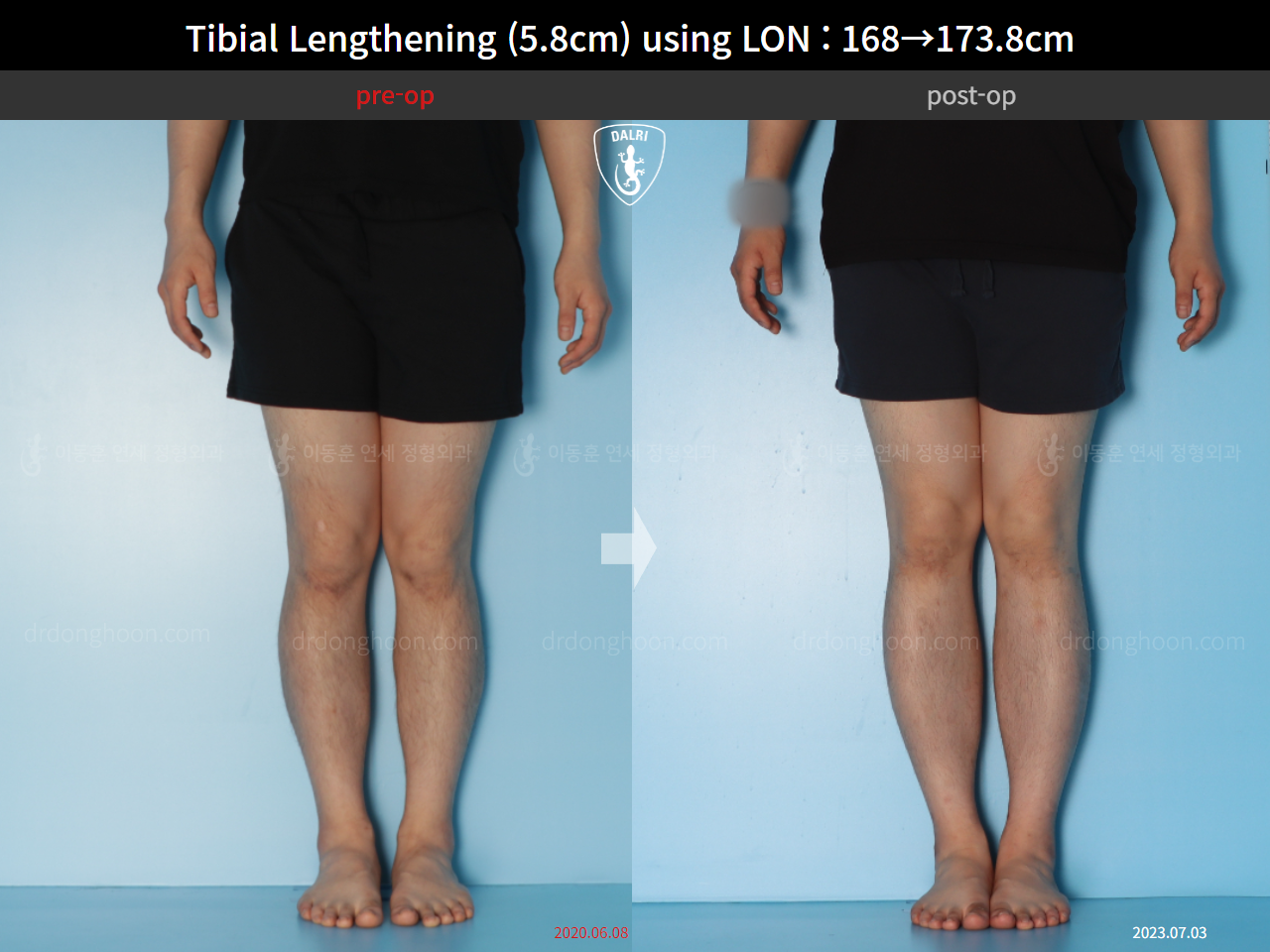 Before and after cll lon, case 15625788, image 5, Dr. Donghoon institute (DALRI)