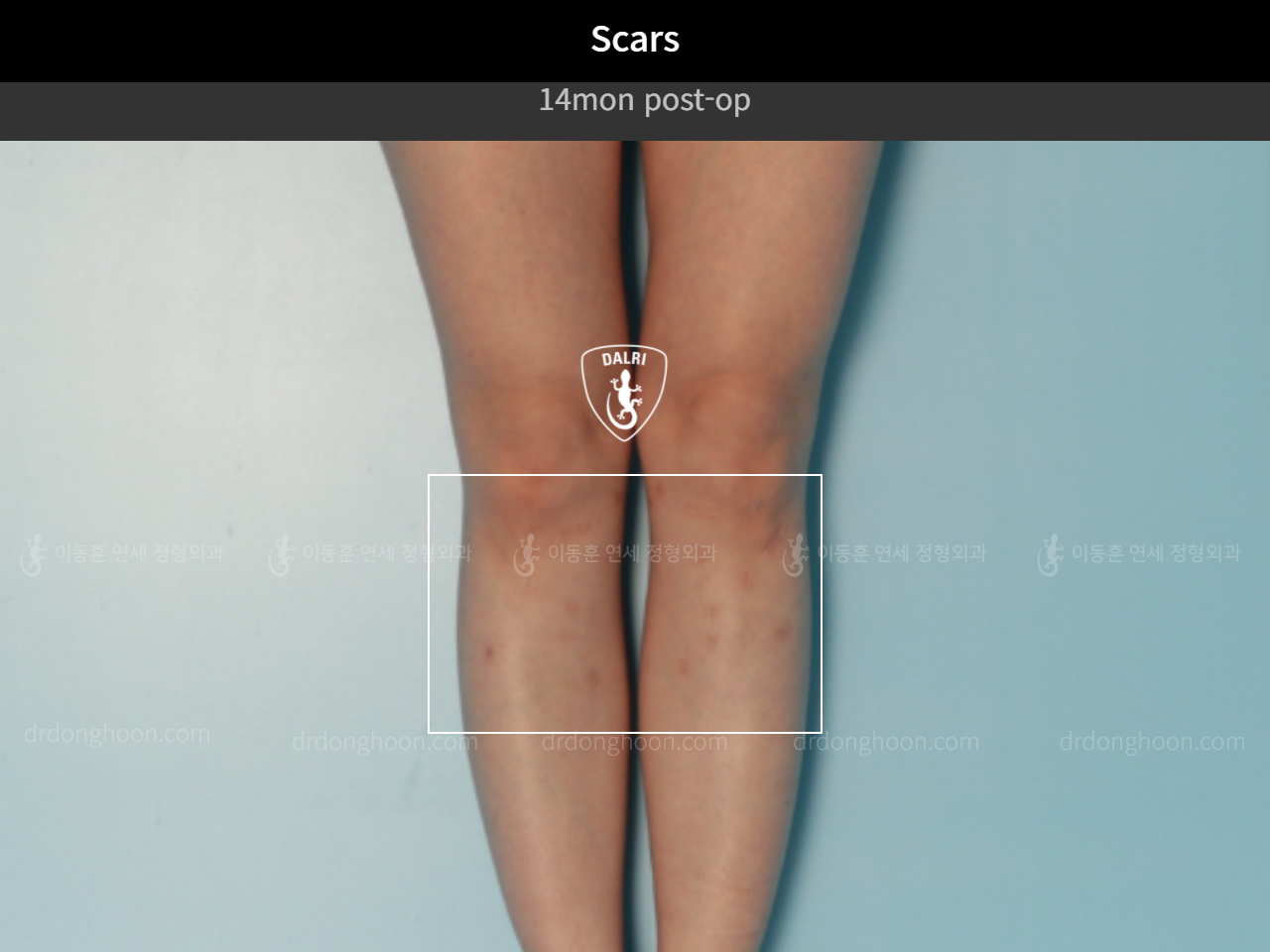 Before and after adult bowlegs, case 9557826, image 5, Dr. Donghoon institute (DALRI)