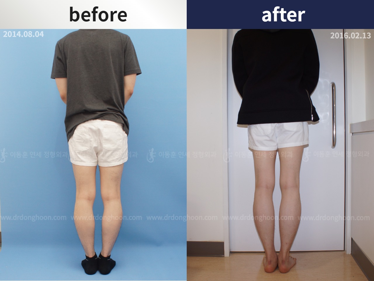 Before and after cll + deformity correction, case 4323134, image 2, Dr. Donghoon institute (DALRI)