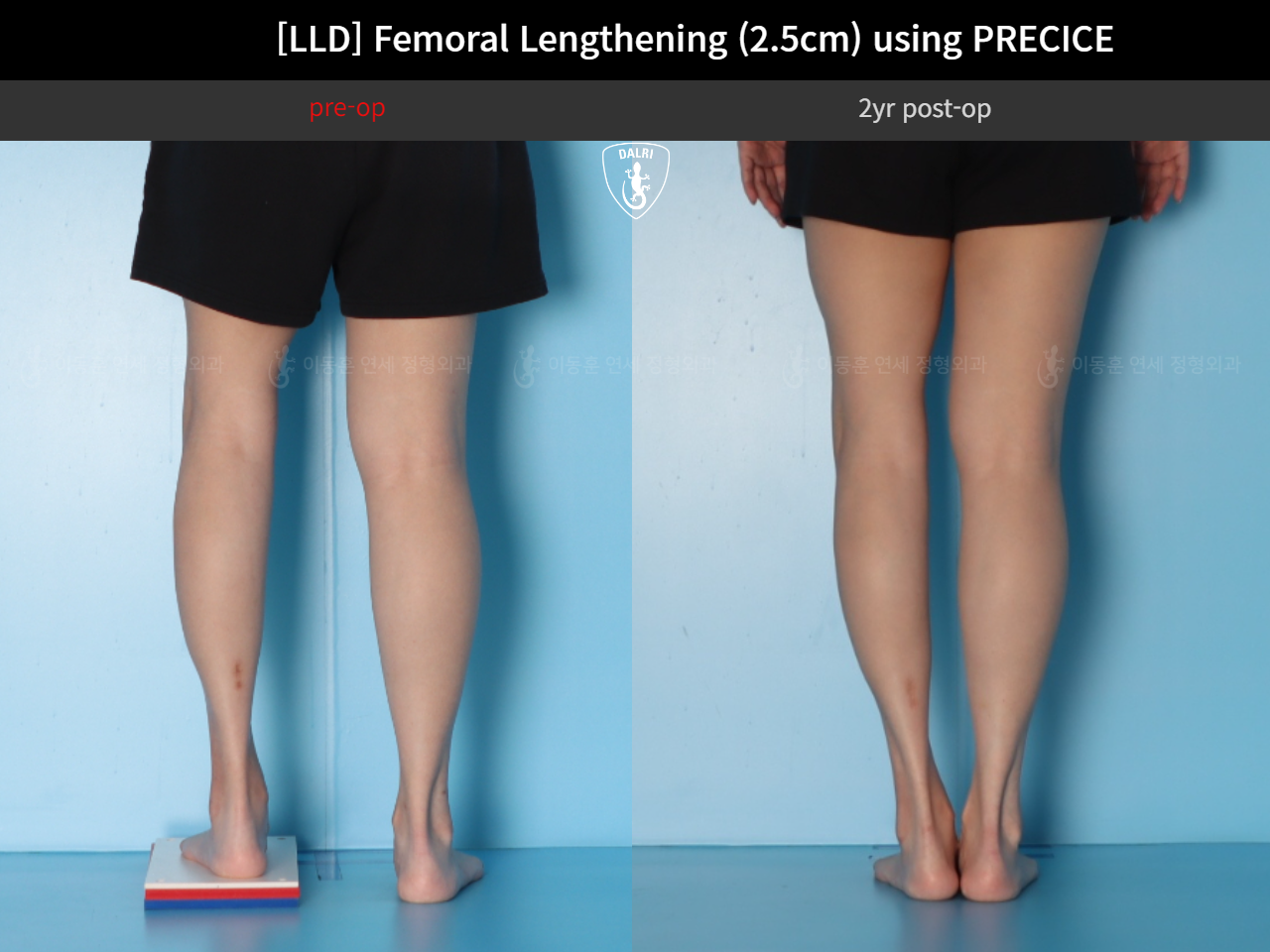 Before and after post-trauma deformity, case 89087952, image 6, Dr. Donghoon institute (DALRI)