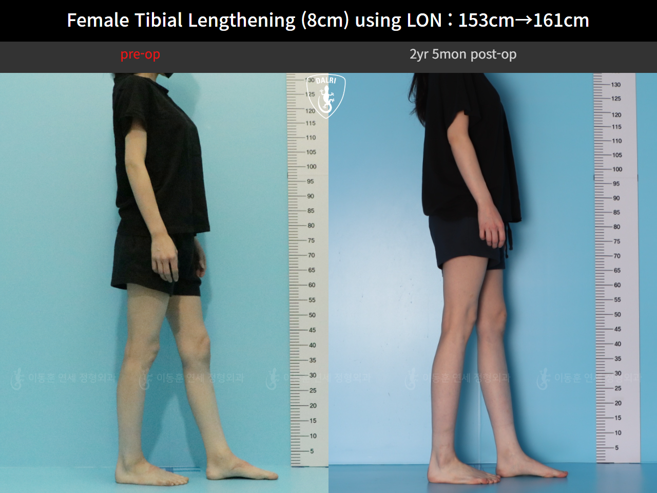 Before and after cll lon, case 128135191, image 5, Dr. Donghoon institute (DALRI)
