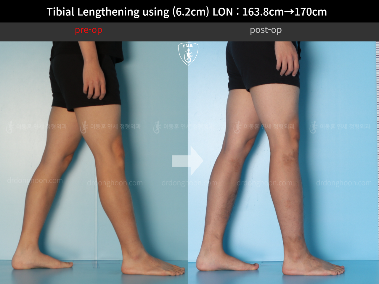 Before and after cll lon, case 13001983, image 8, Dr. Donghoon institute (DALRI)