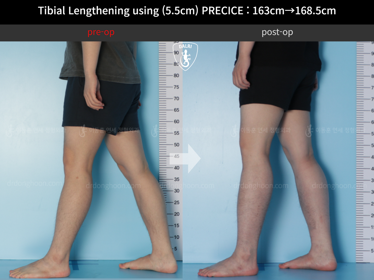 Before and after cll precice, case 12336162, image 6, Dr. Donghoon institute (DALRI)