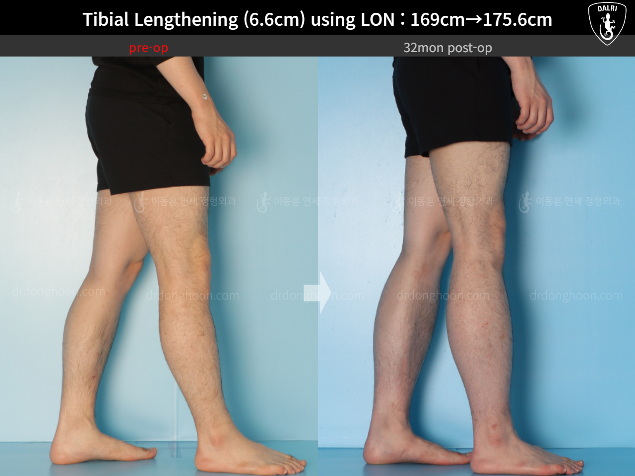 Before and after cll lon, case 15166302, image 12, Dr. Donghoon institute (DALRI)