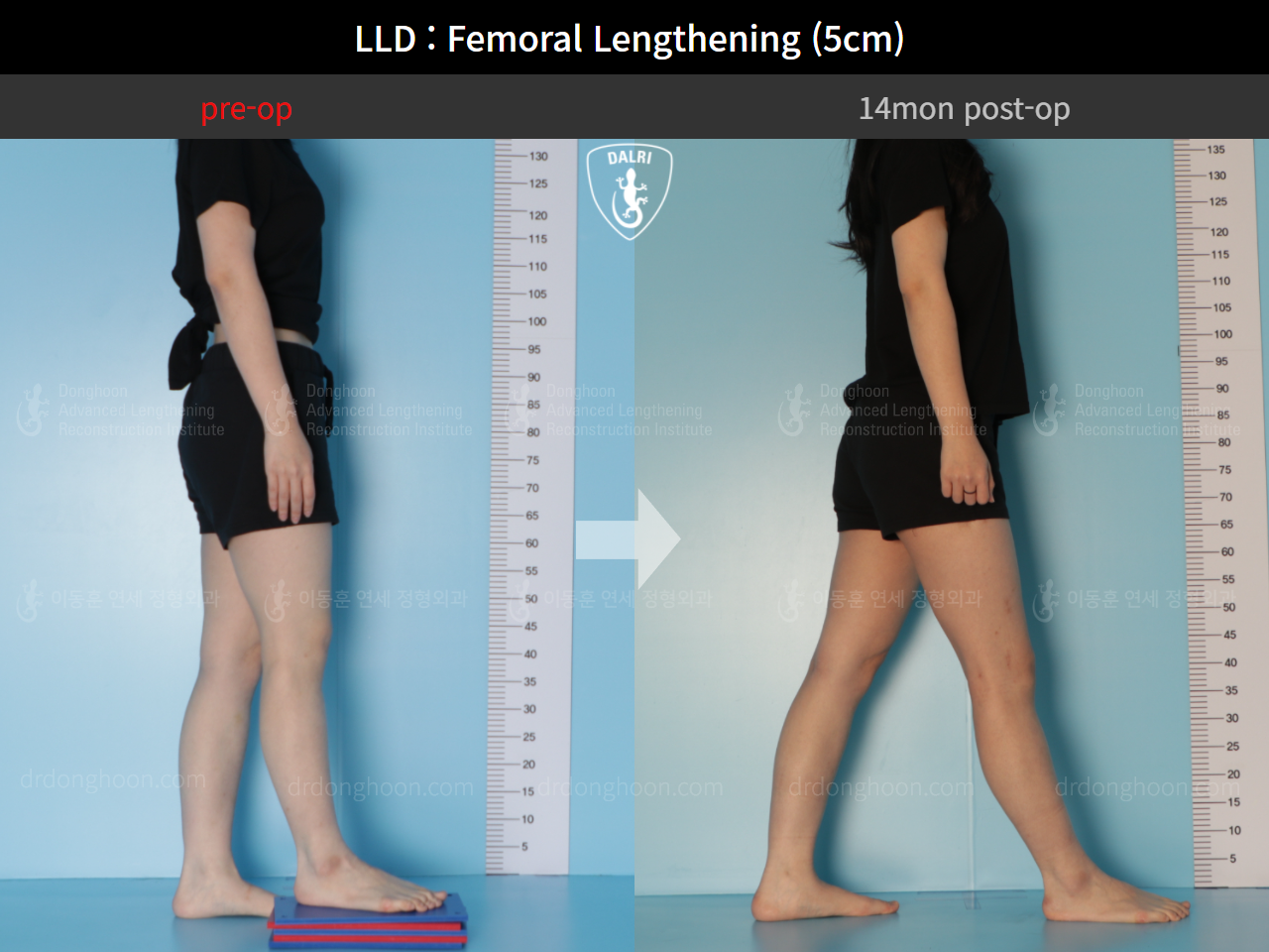 Before and after adult lld, case 9366304, image 5, Dr. Donghoon institute (DALRI)
