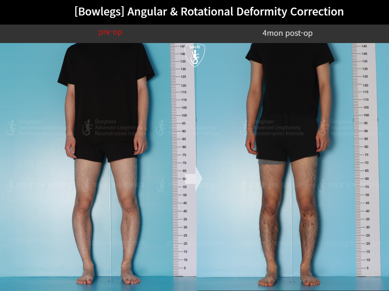 Before and after adult bowlegs, case 18071382, image 3, Dr. Donghoon institute (DALRI)