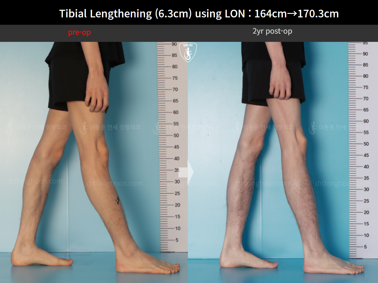 Before and after cll lon, case 16723608, image 11, Dr. Donghoon institute (DALRI)