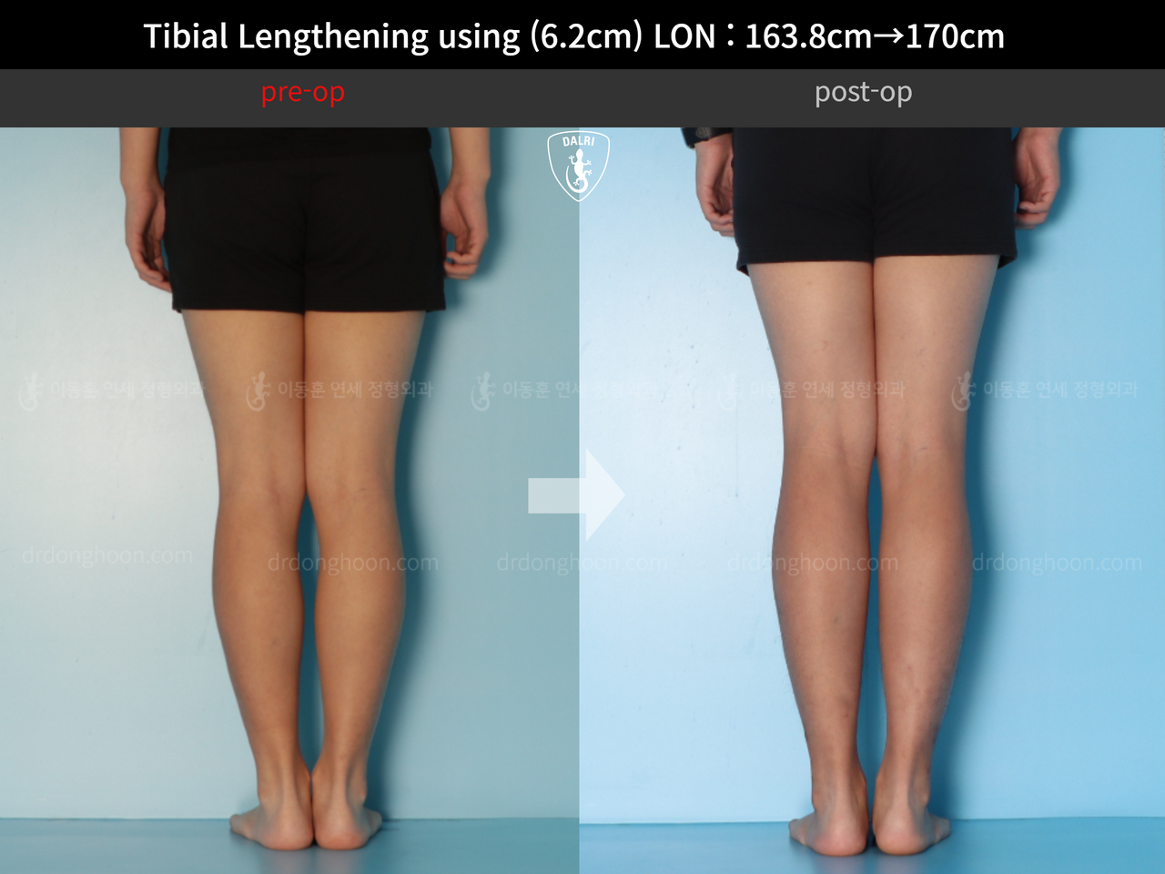 Before and after cll lon, case 13001983, image 6, Dr. Donghoon institute (DALRI)