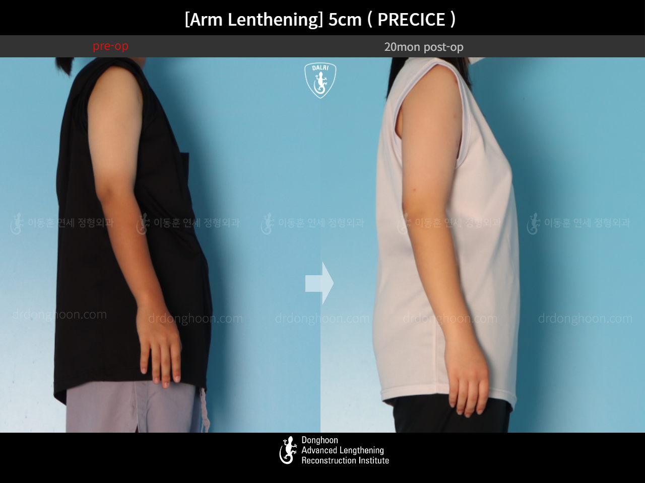 Before and after arm lengthening, case 18471704, image 6, Dr. Donghoon institute (DALRI)