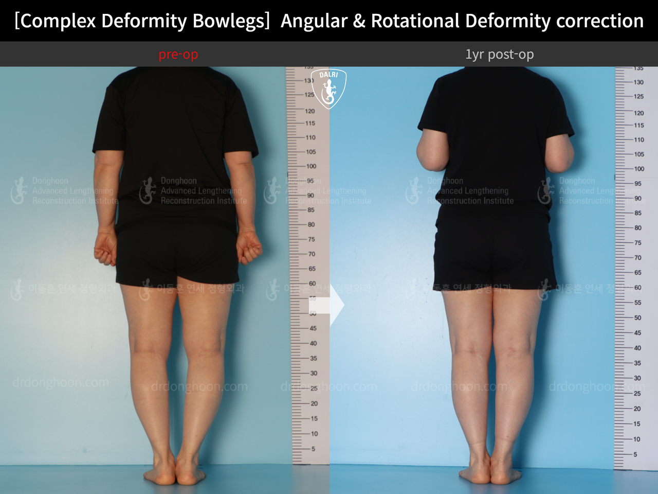 Before and after adult bowlegs, case 14378683, image 3, Dr. Donghoon institute (DALRI)