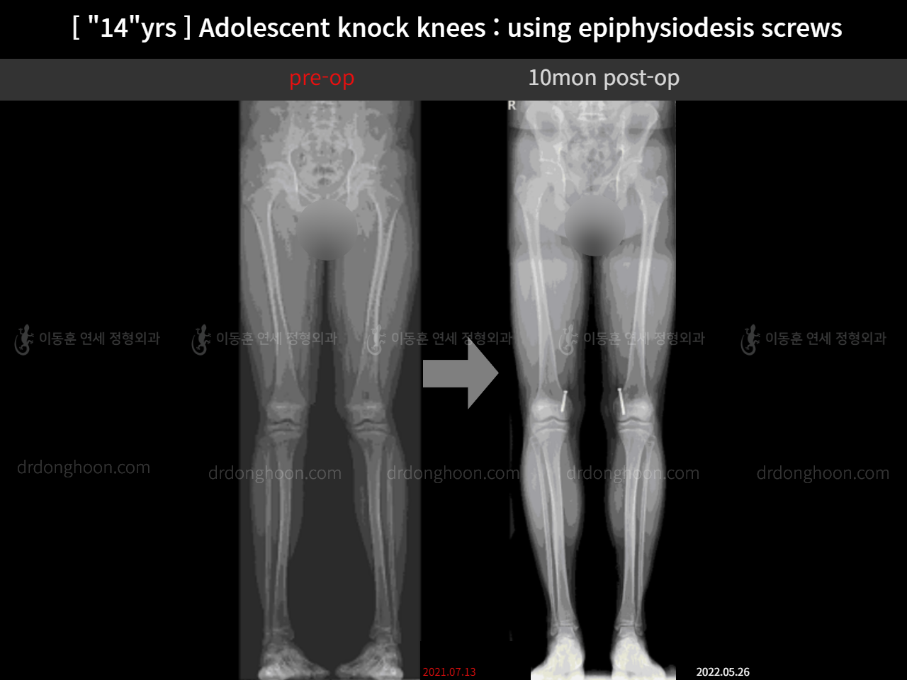 Before and after paediatric & adolescent knock knees, case 11674972, image 5, Dr. Donghoon institute (DALRI)