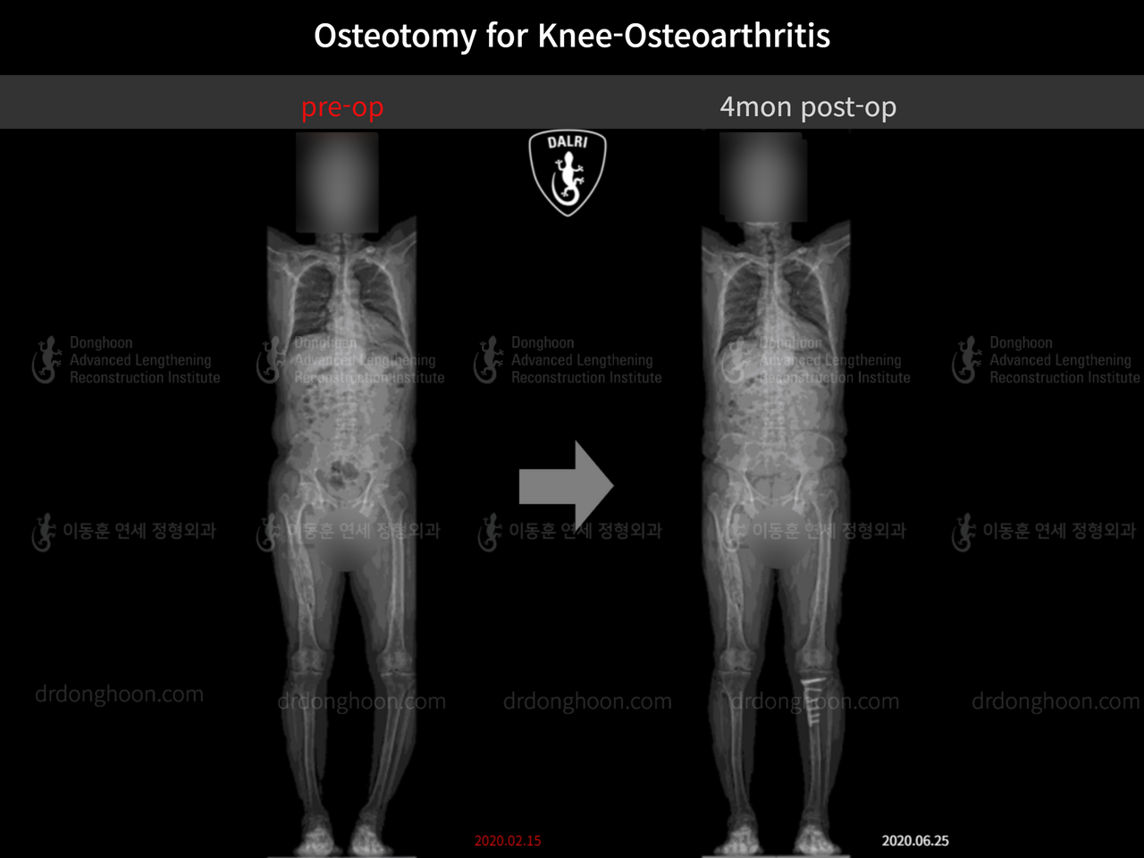 Before and after osteotomy for knee osteoarthritis, case 12535590, image 9, Dr. Donghoon institute (DALRI)