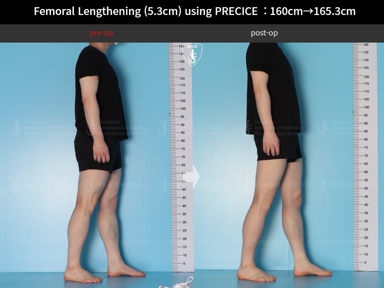 Before and after cll precice, case 18250566, image 4, Dr. Donghoon institute (DALRI)