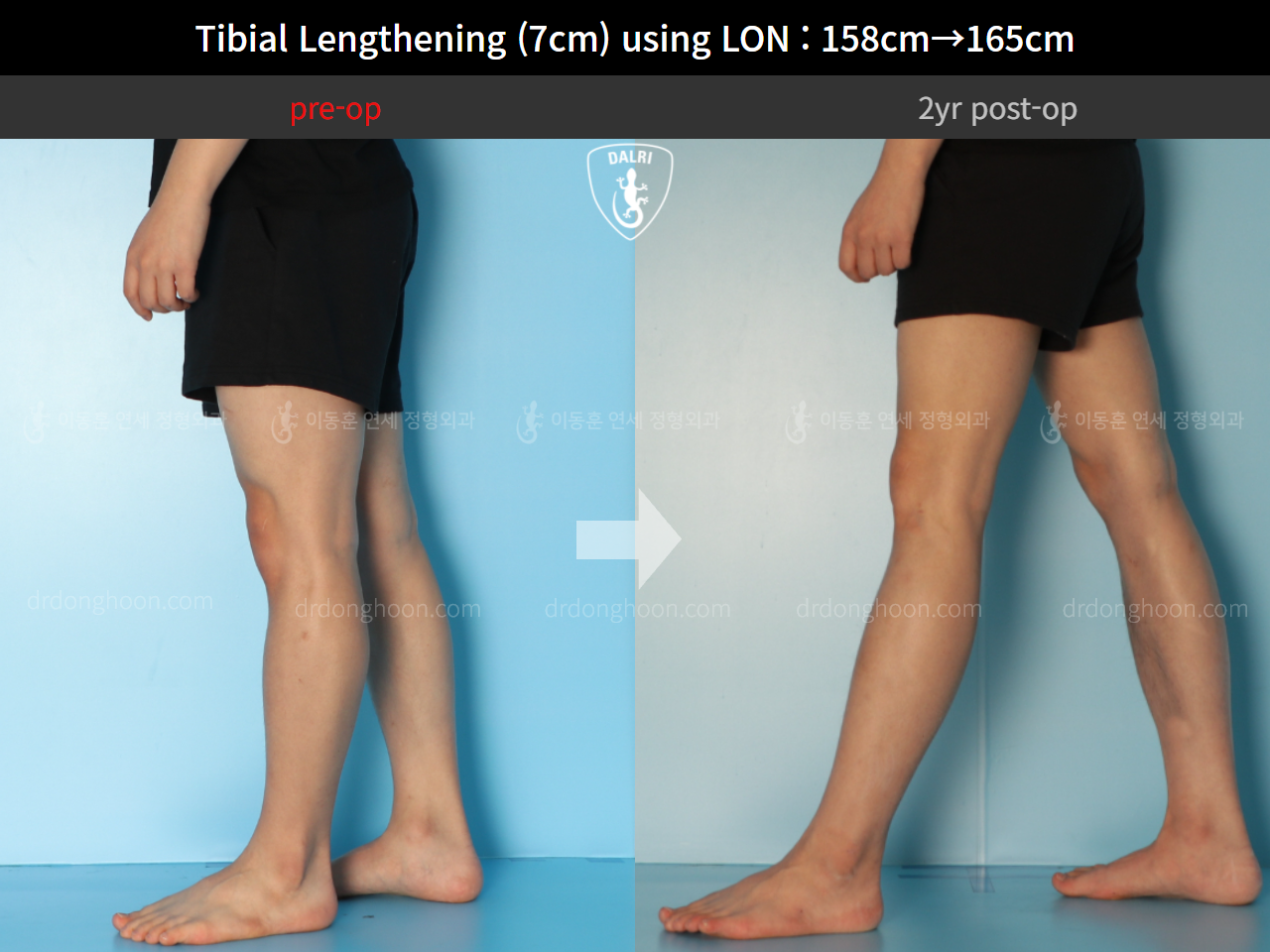 Before and after cll lon, case 9325768, image 8, Dr. Donghoon institute (DALRI)
