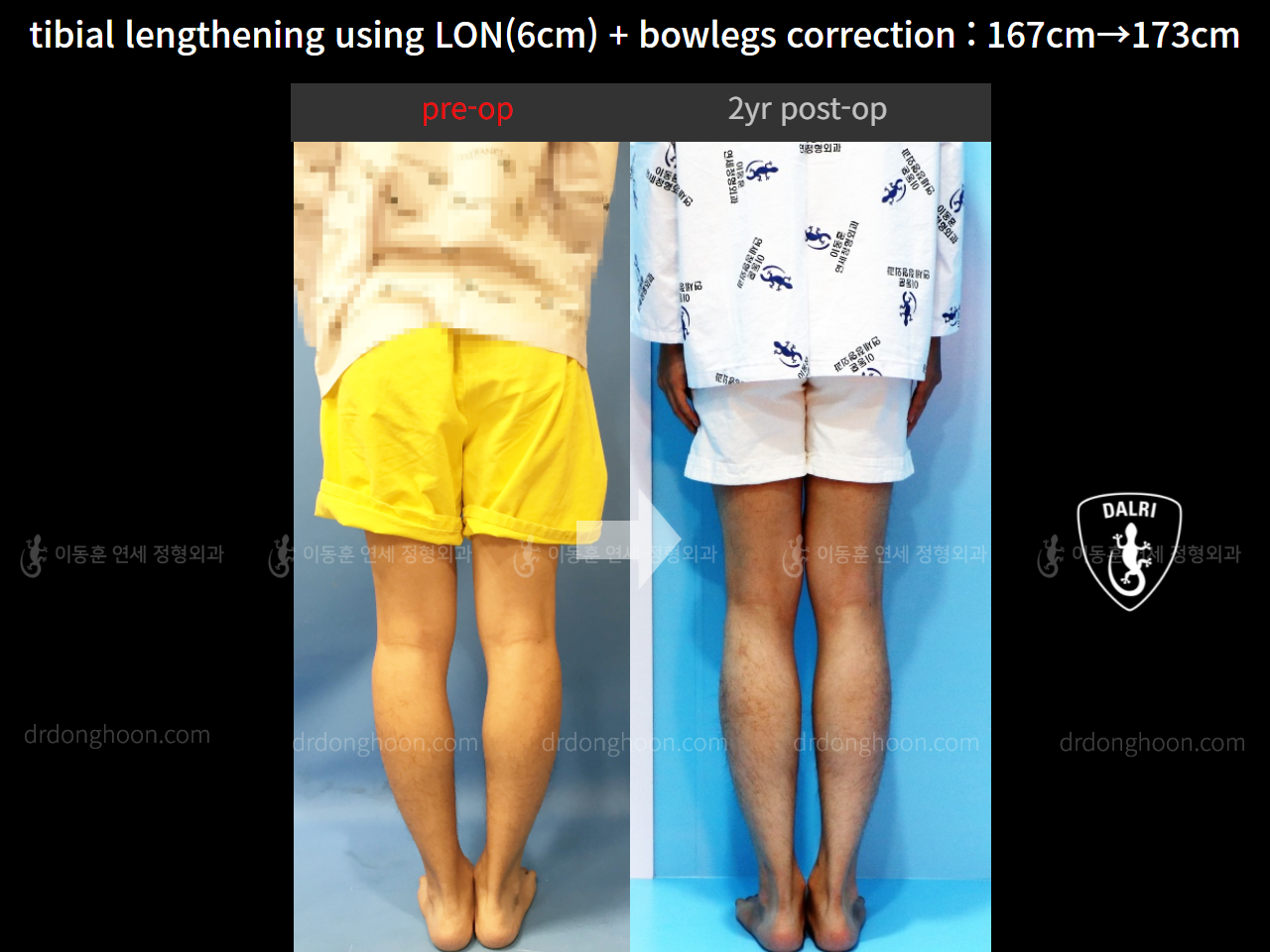 Before and after cll + deformity correction, case 4323147, image 2, Dr. Donghoon institute (DALRI)
