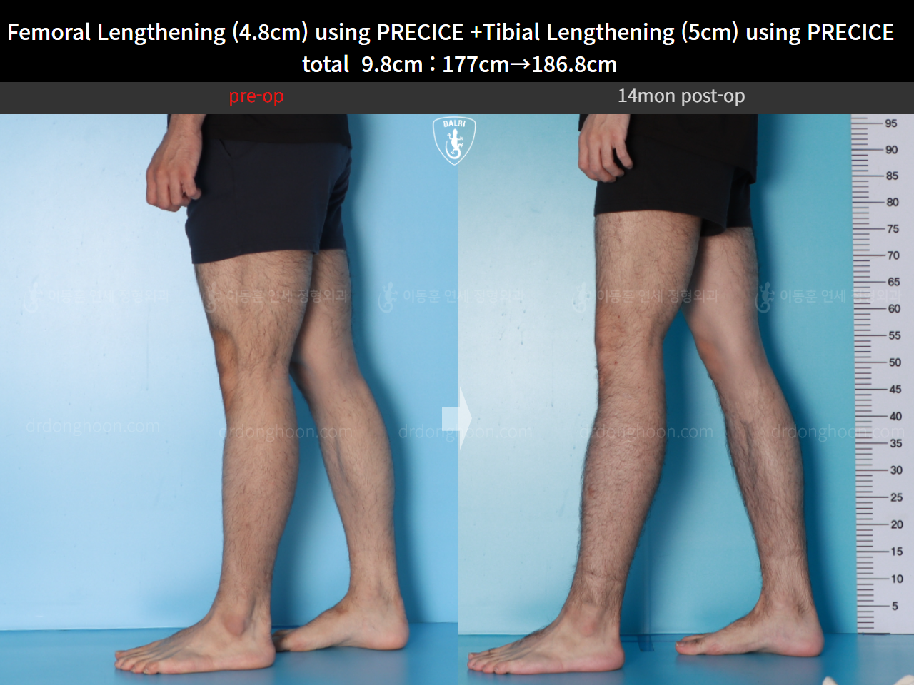 Before and after cll precice, case 16780196, image 10, Dr. Donghoon institute (DALRI)