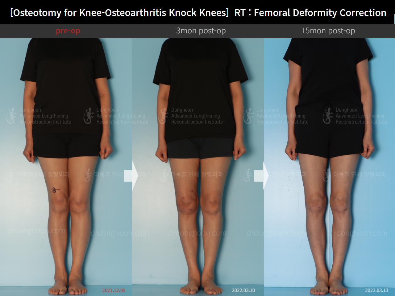 Before and after osteotomy for knee osteoarthritis, case 14462707, image 1, Dr. Donghoon institute (DALRI)