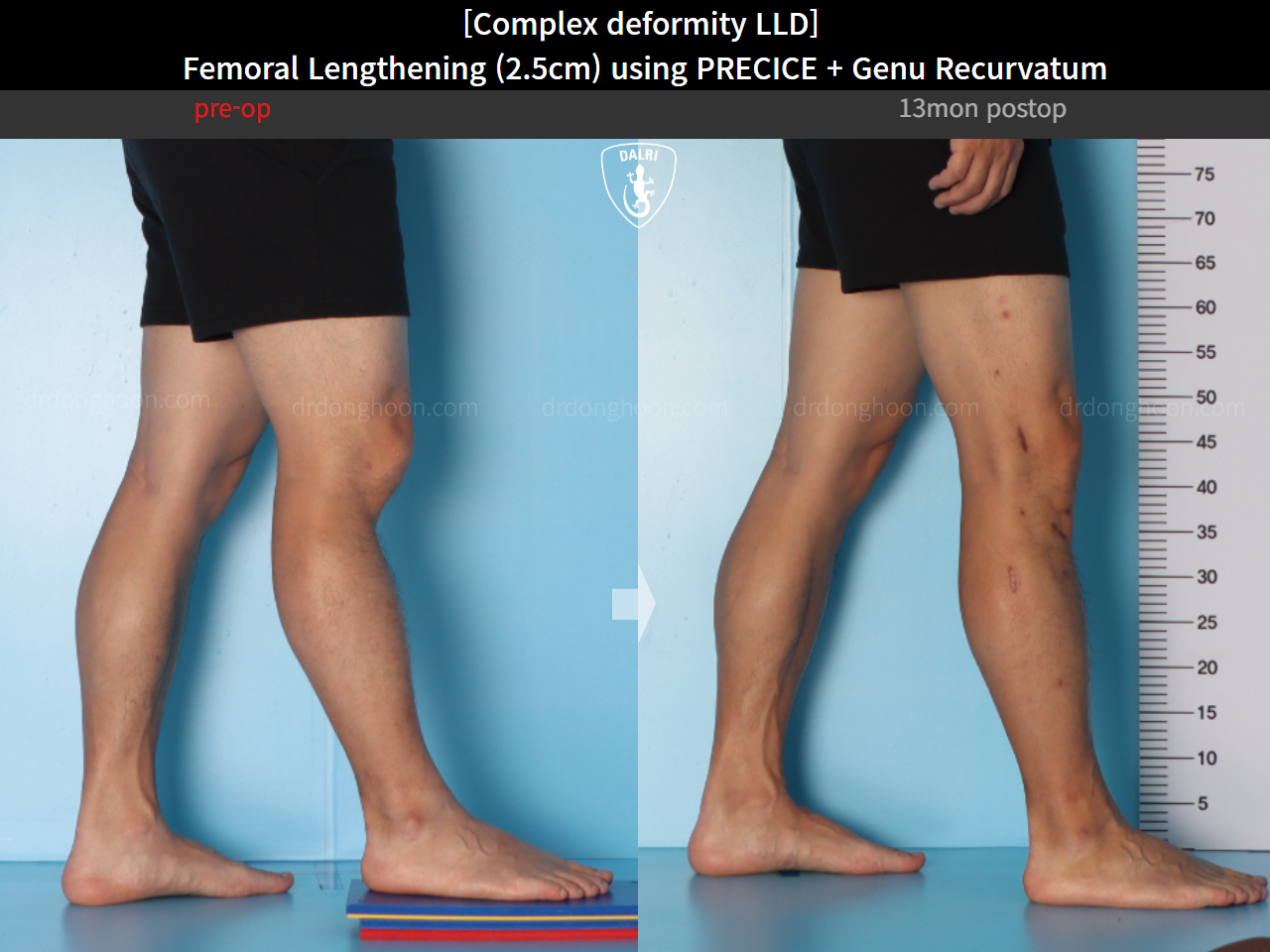 Before and after adult lld, case 16854698, image 9, Dr. Donghoon institute (DALRI)