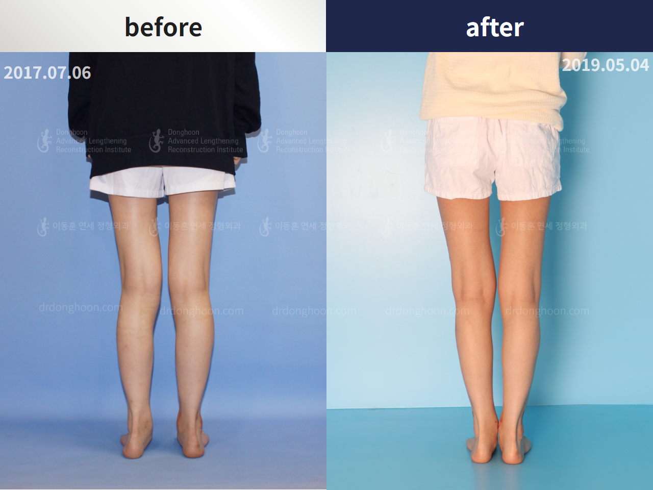 Before and after congenital condition, case 4304672, image 2, Dr. Donghoon institute (DALRI)