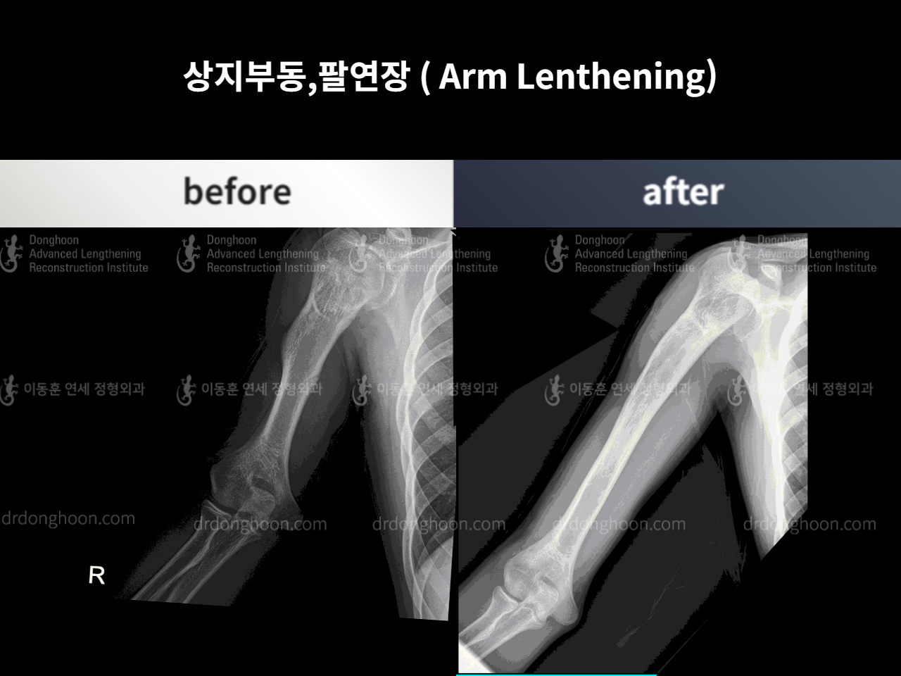 Before and after arm lengthening, case 4249350, image 1, Dr. Donghoon institute (DALRI)