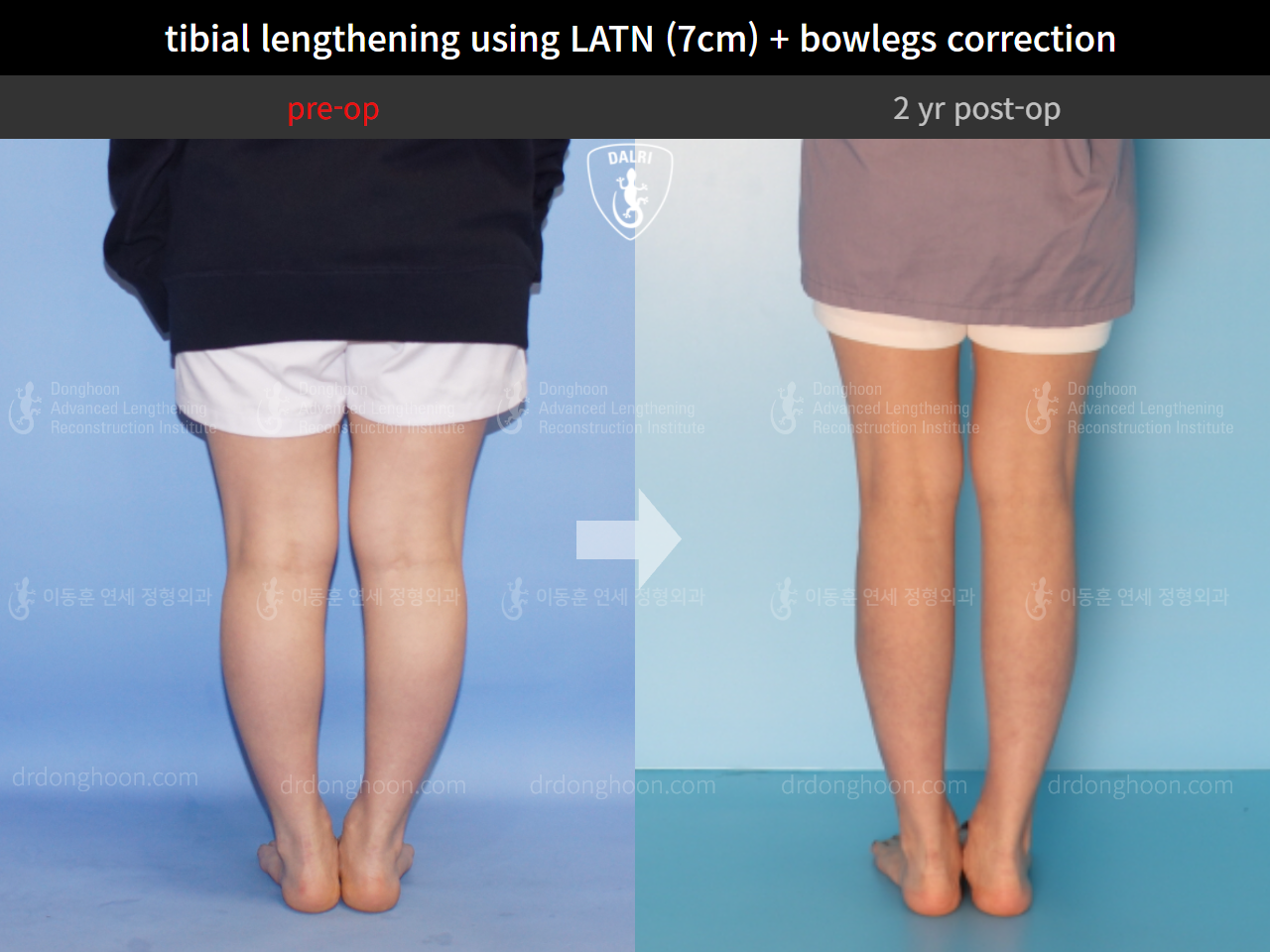 Before and after cll + deformity correction, case 9278561, image 6, Dr. Donghoon institute (DALRI)