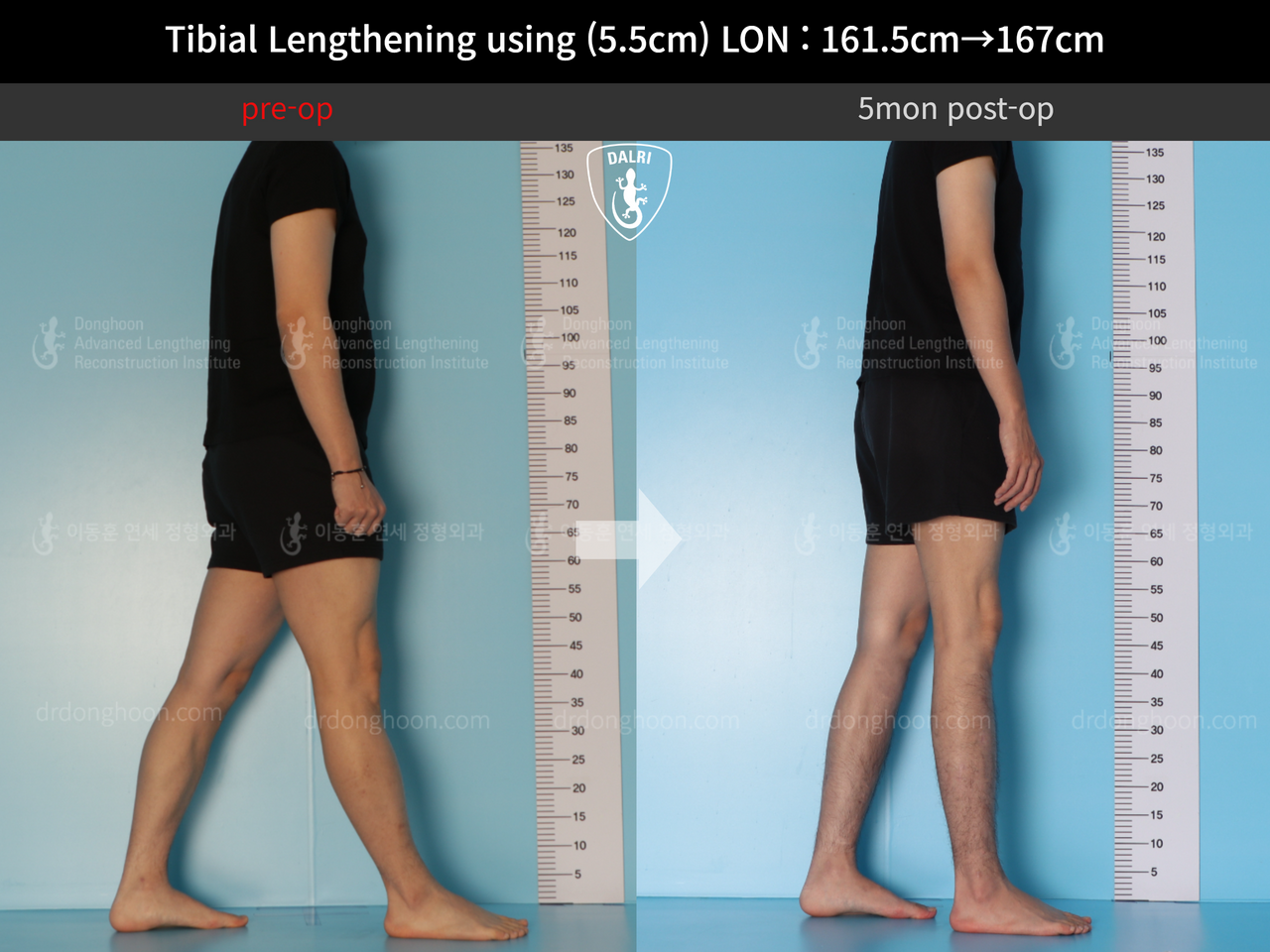 Before and after cll lon, case 12641751, image 3, Dr. Donghoon institute (DALRI)