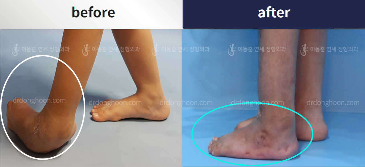 Before and after foot & ankle deformity, case 4367967, image 2, Dr. Donghoon institute (DALRI)