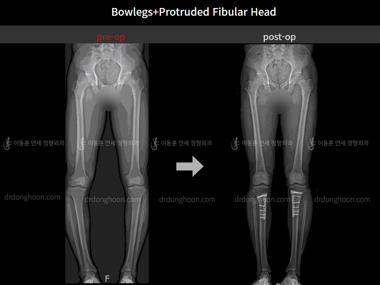 Before and after protruded fibular head, case 4248372, image 6, Dr. Donghoon institute (DALRI)