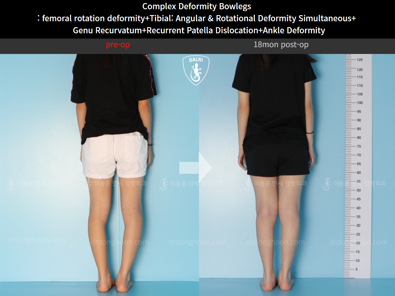 Before and after adult bowlegs, case 11243996, image 3, Dr. Donghoon institute (DALRI)