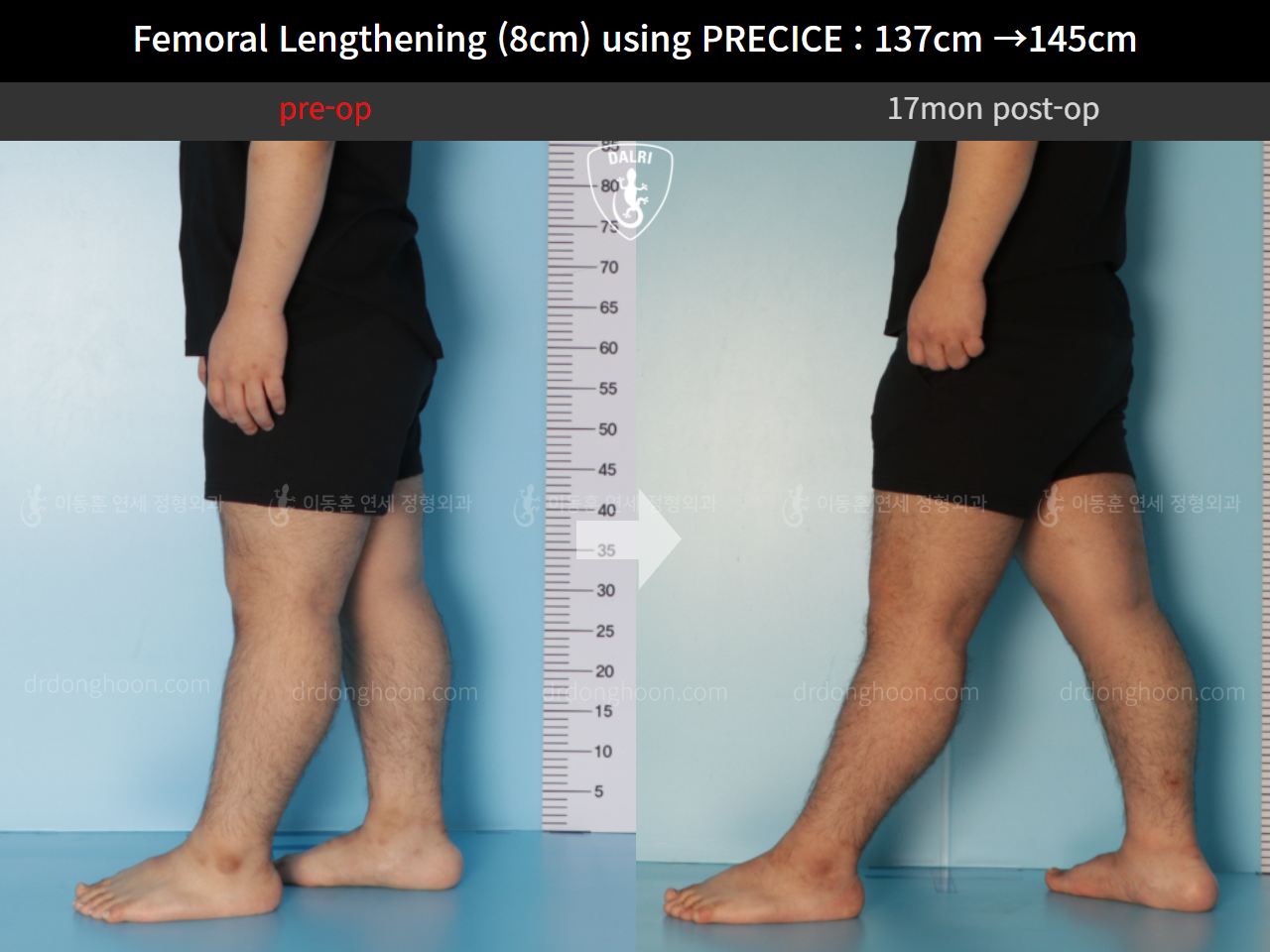 Before and after cll precice, case 9658893, image 8, Dr. Donghoon institute (DALRI)
