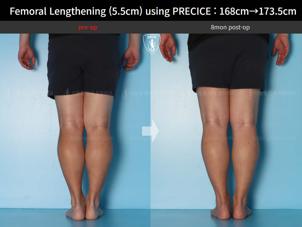 Before and after cll precice, case 16910900, image 8, Dr. Donghoon institute (DALRI)