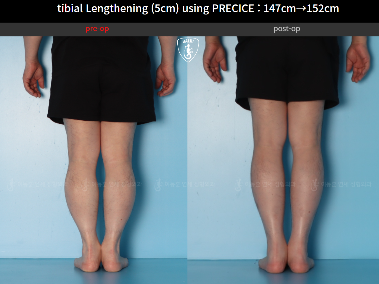 Before and after cll precice, case 89098588, image 8, Dr. Donghoon institute (DALRI)