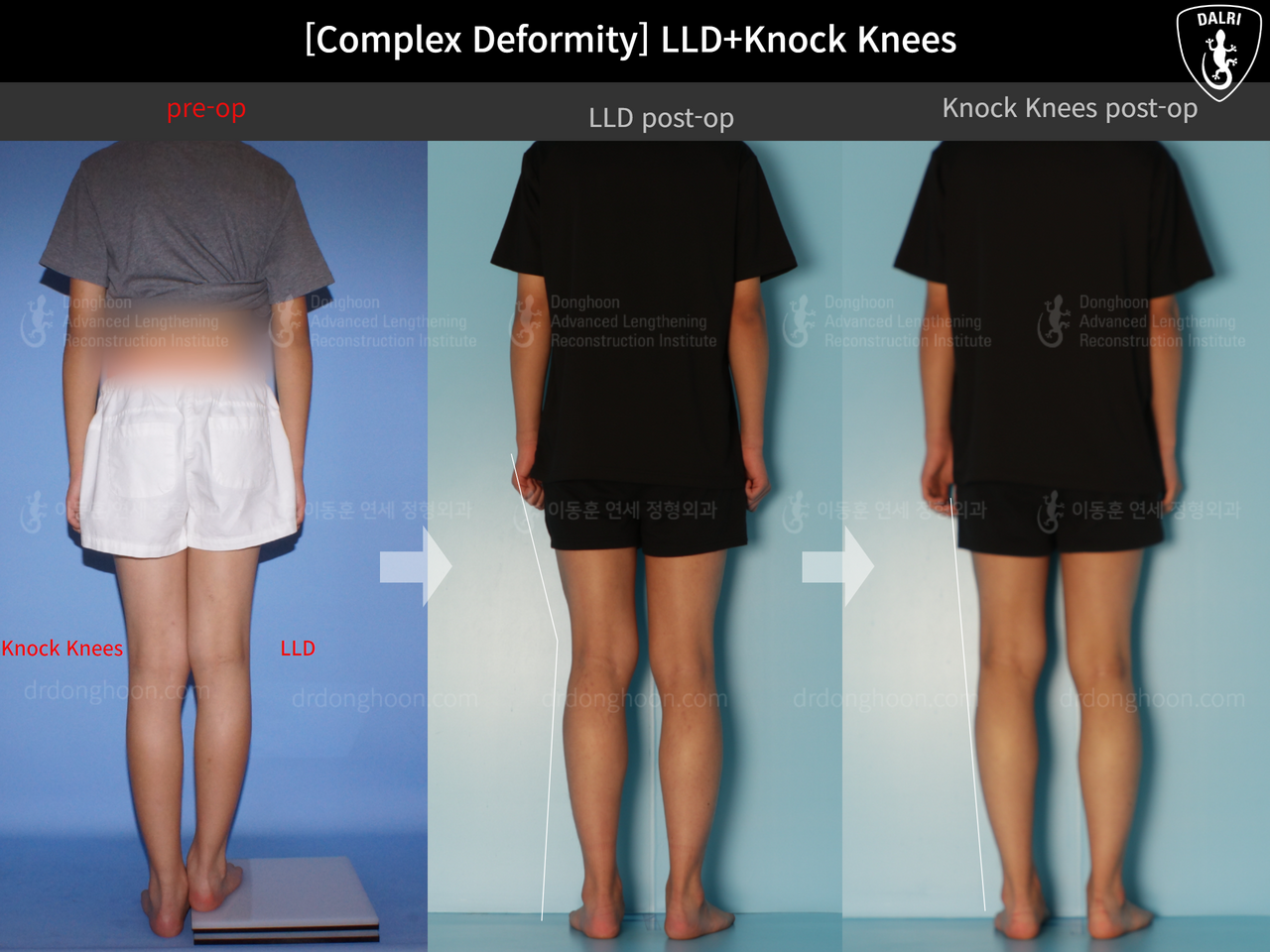 Before and after paediatric & adolescent knock knees, case 12476075, image 2, Dr. Donghoon institute (DALRI)
