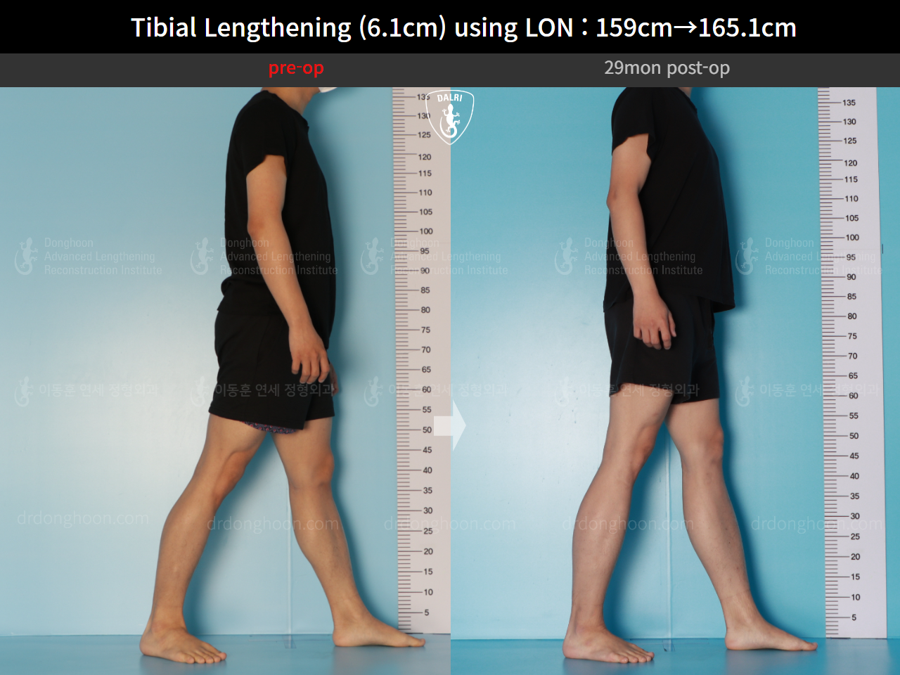 Before and after cll lon, case 16723424, image 6, Dr. Donghoon institute (DALRI)