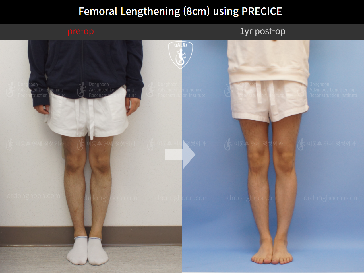 Before and after cll precice, case 4323392, image 2, Dr. Donghoon institute (DALRI)
