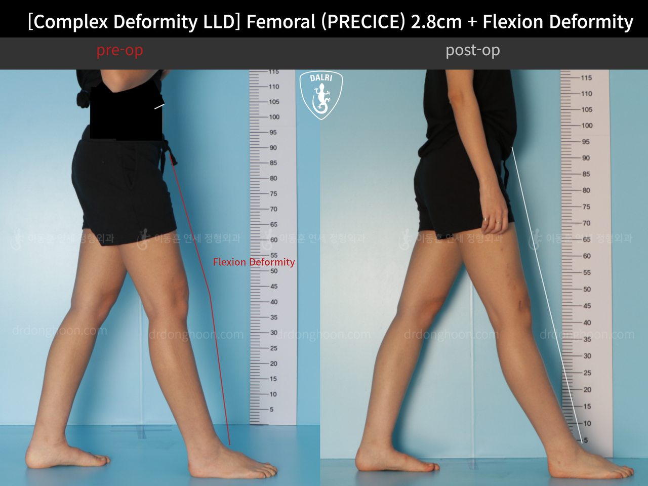 Before and after complex deformity, case 13168223, image 6, Dr. Donghoon institute (DALRI)