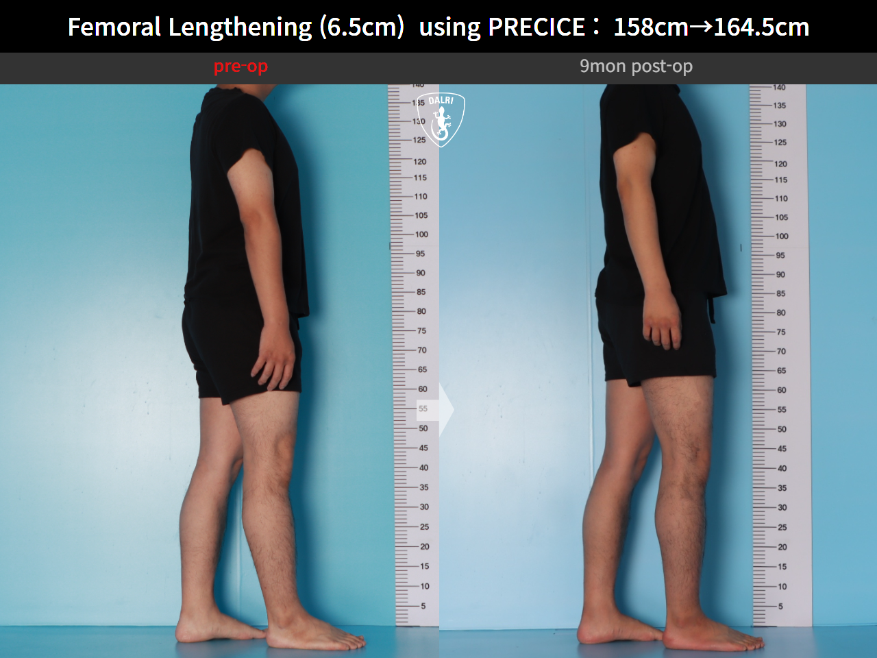 Before and after cll precice, case 28297898, image 5, Dr. Donghoon institute (DALRI)