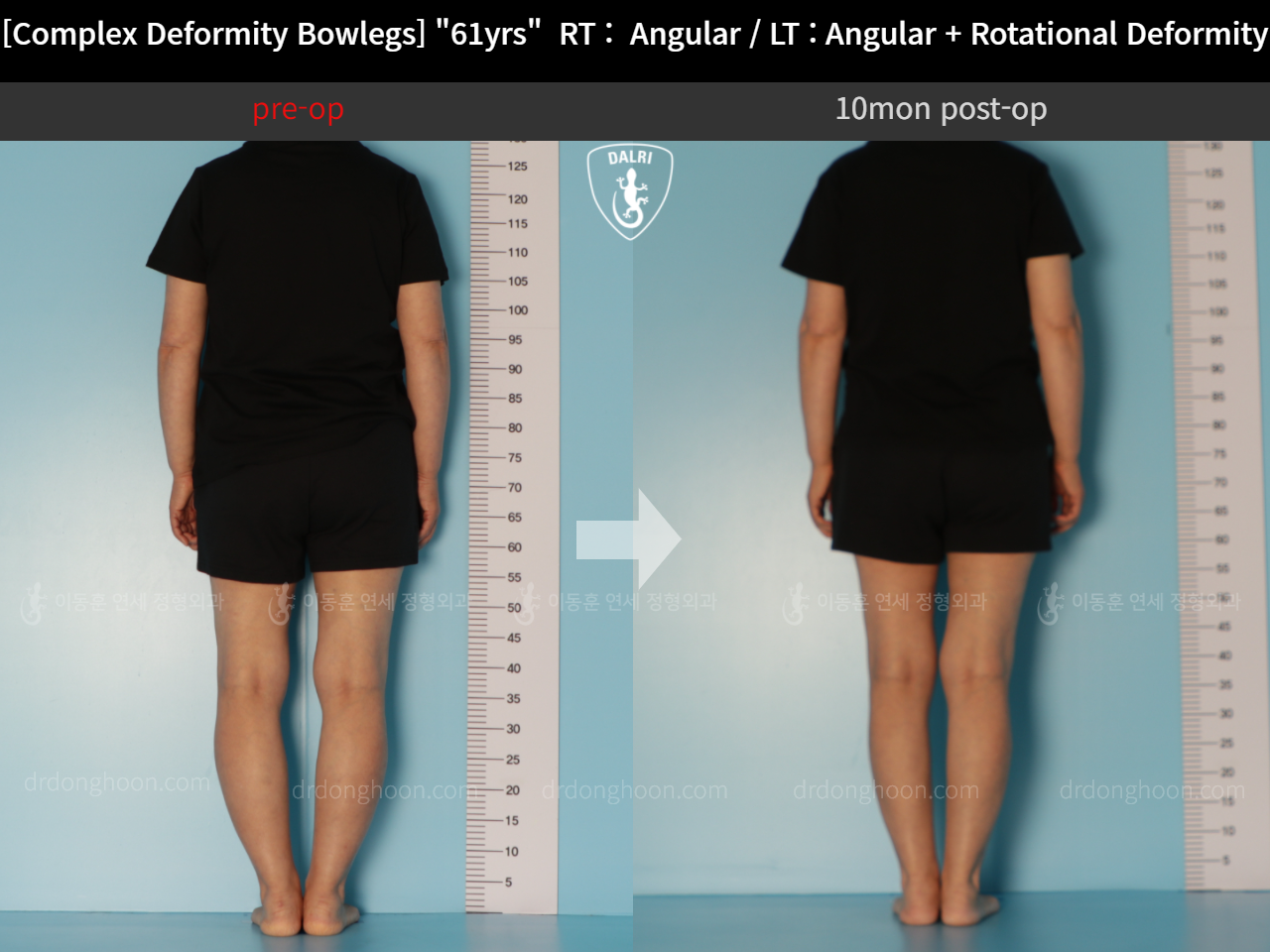 Before and after adult bowlegs, case 11576427, image 4, Dr. Donghoon institute (DALRI)