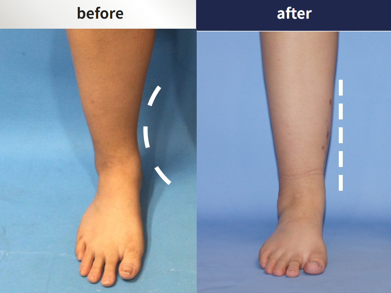 Before and after foot & ankle deformity, case 4247987, image 1, Dr. Donghoon institute (DALRI)
