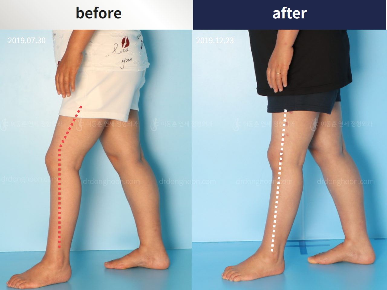 Before and after complex deformity, case 4251607, image 4, Dr. Donghoon institute (DALRI)